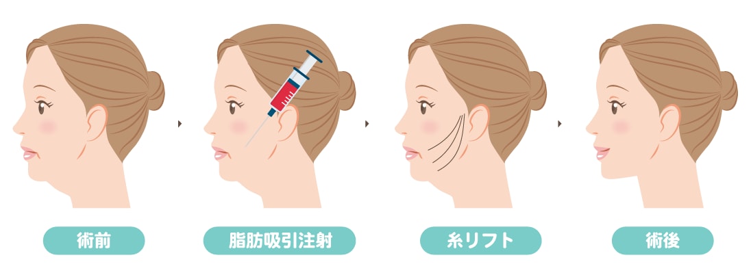 糸リフト×脂肪吸引注射